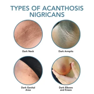 Fivfivgo™ Acanthosis Nigricans Aufhellungscreme