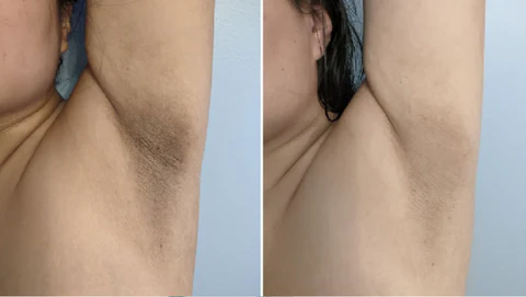 Fivfivgo™ Acanthosis Nigricans Aufhellungscreme