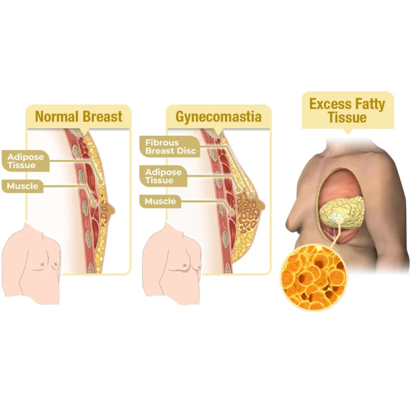 LIMETOW™ MenTherm Bee Venom Gynecomastia Heating Oil