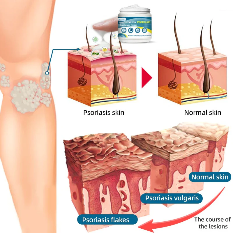 Negusy™ Multi-Symptom Psoriasis Treatment Cream