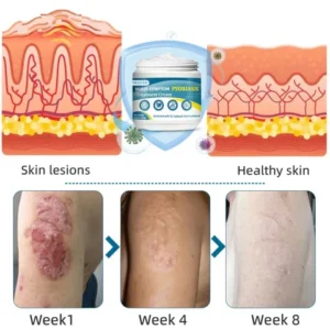 Negusy™ Multi-Symptom Psoriasis Treatment Cream