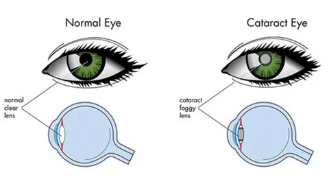 Optixa™ Cataracts & Glaucoma Eye Drops