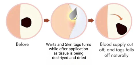 WREE™ Bee Venom Wart & Tag Removal Cream