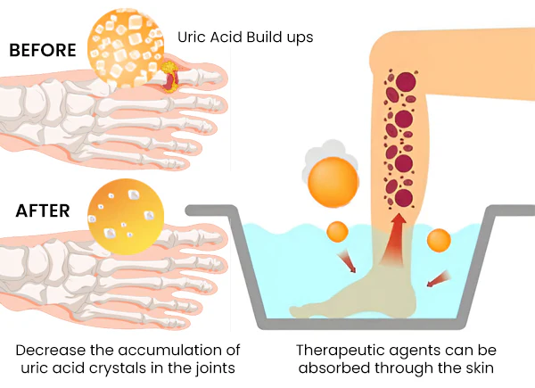 OsteoBee™ Gout Relief Foot Soak