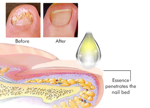 AEXZR™ Toe Nail Treatment Gel