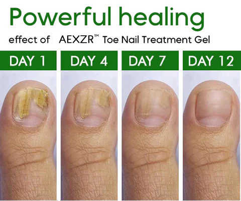 AEXZR™ Toe Nail Treatment Gel