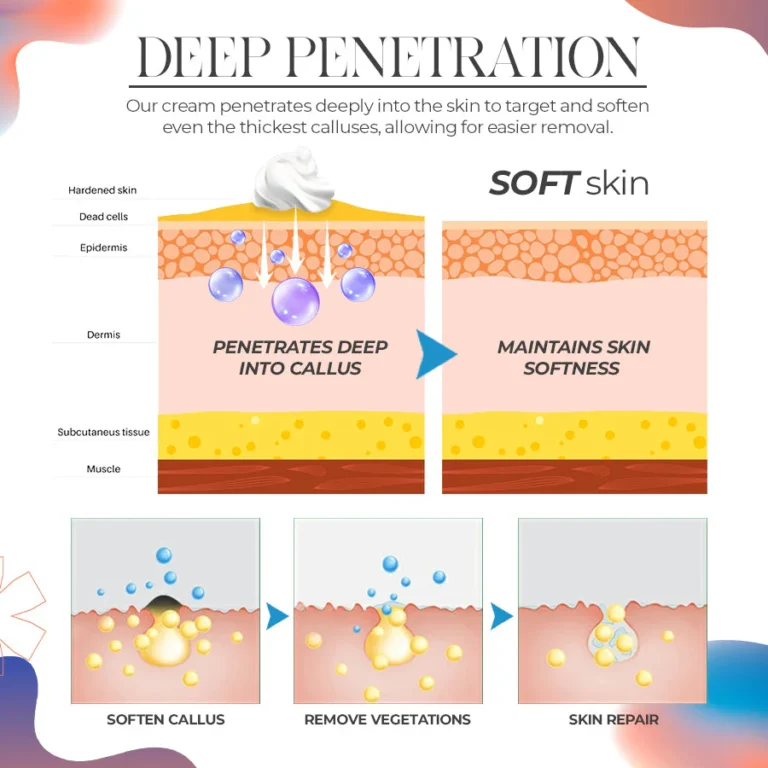 CallusPro™Calluses Remove Cream
