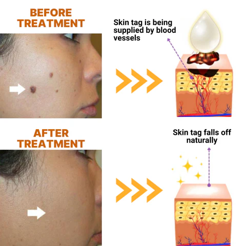 Dermvene™ Organic Skin Tag Solution