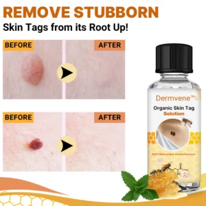 Dermvene™ Organic Skin Tag Solution