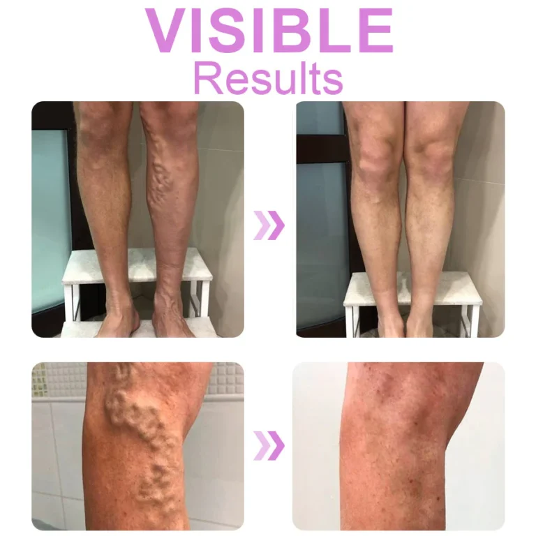 Dobshow™ Varicose Veins Cream