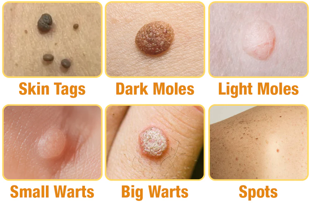 FLYCARE™ Bee Venom Tags & Moles Remover