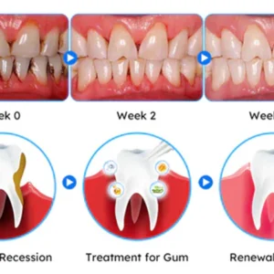 Nurbini™ Gum Therapy Gel