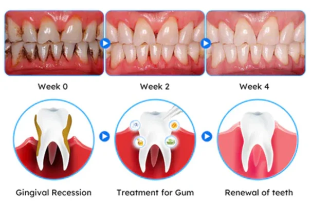 Nurbini™ Gum Therapy Gel