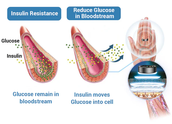Oveallgo™ SugarWell Micro-Electrotherapy GlucoRing+