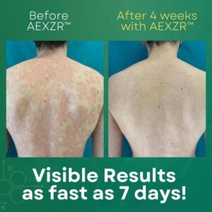 AEXZR™ Psoriasis Cream