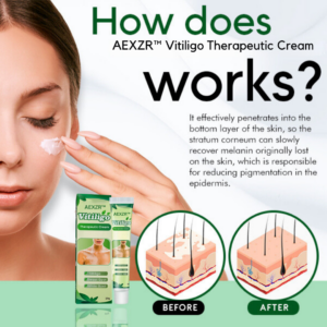 AEXZR™ Vitiligo Therapeutic Cream