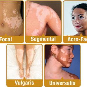 BEEVENOM VITILIGO TREATMENT CREAM