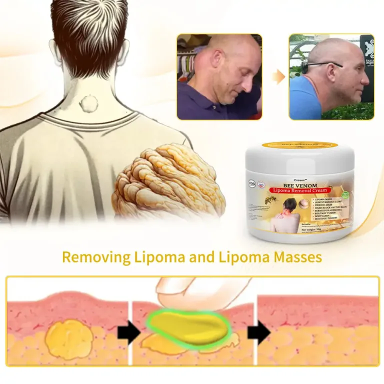 Bee Venom Lipoma Removal Cream