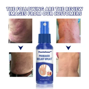 ORGANIC PSORIASIS CHICKWEED RELIEF SPRAY