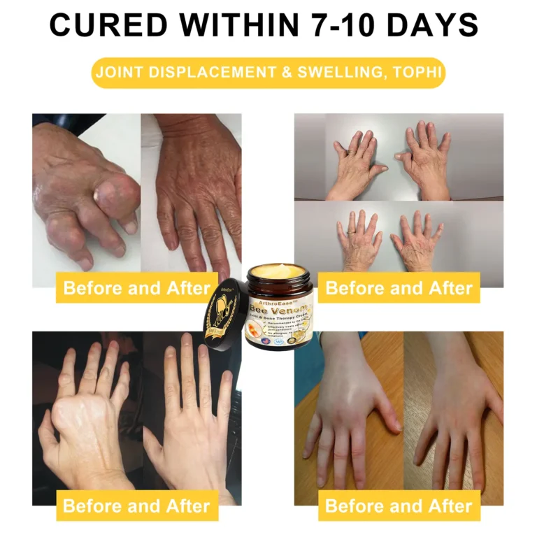 𝐒𝐩𝐳𝐯™ Bee Venom Arthritis Therapy Cream(Specially for older adults & AAOS recommends)