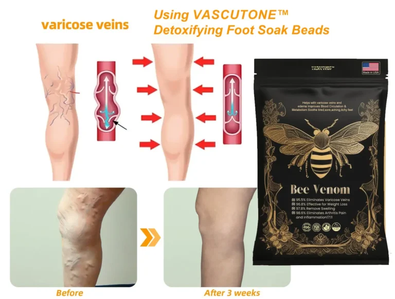 VascuTone™ Bee venom lymphatic detoxification slimming foot bath beads