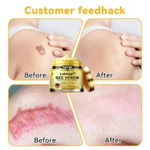 [Winter-Skincare] Lotmay™ Bee Venom Skin Treatment Cream（AAD RECOMMENDED）