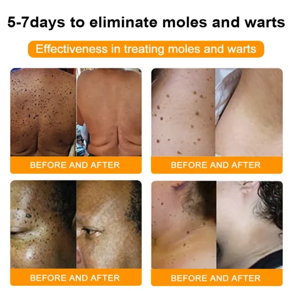 AQA™ Natural Bee Essence Mole and Wart Treatment Cream - Image 4