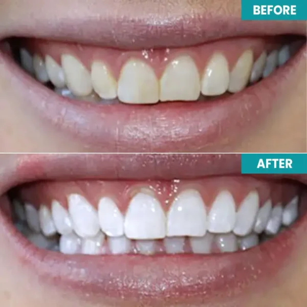 LIMETOW™ Instant Teeth Whitening Paint - Image 8