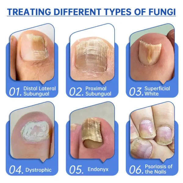 QIAWI™ PureNail Fungus Laser Device - Image 11